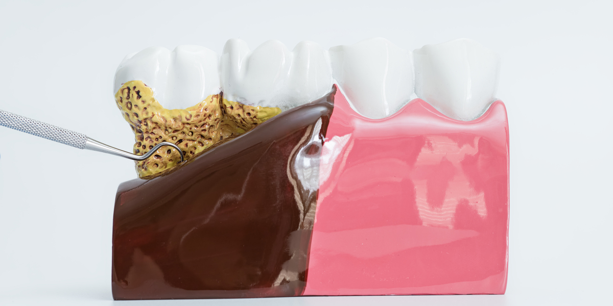 重度歯周病にも対応できる非外科的治療