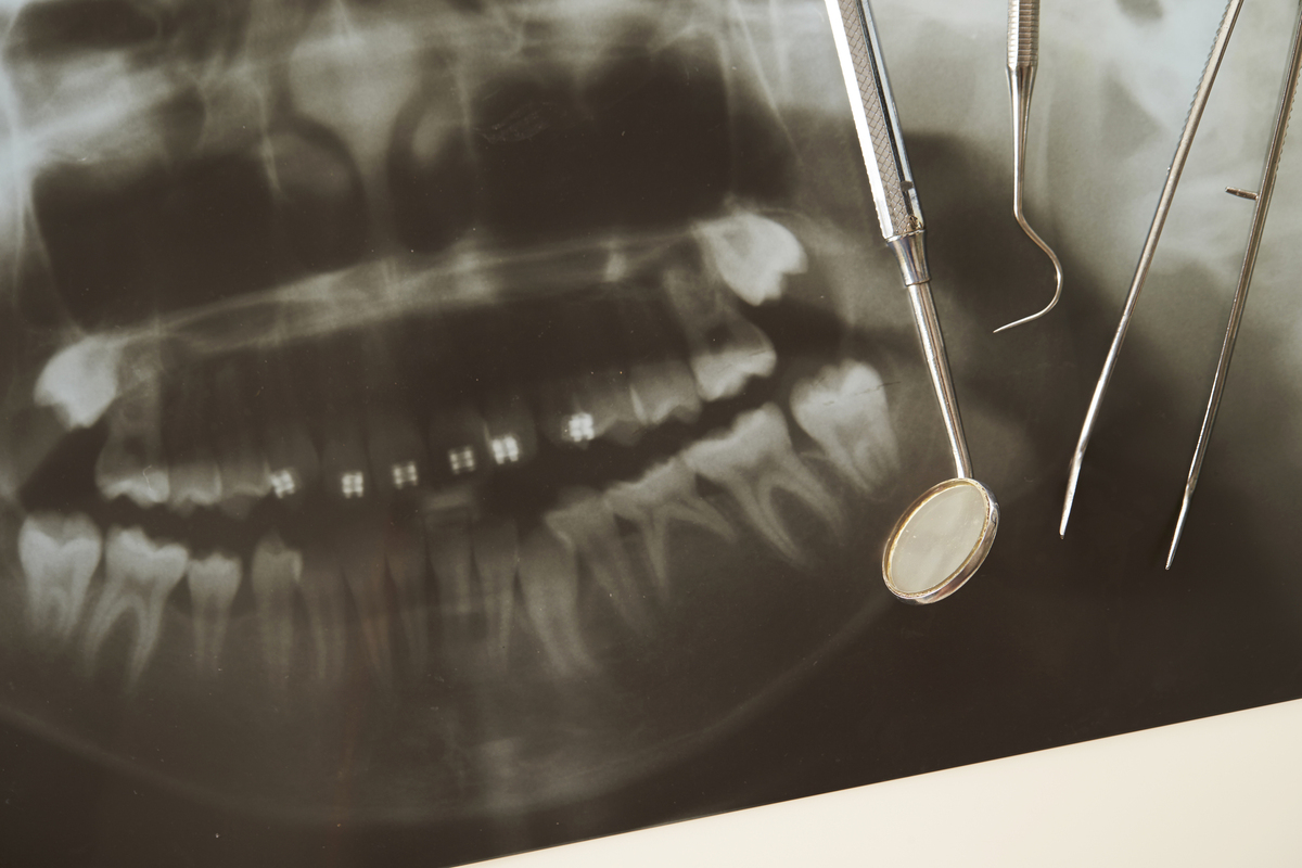 レントゲン撮影