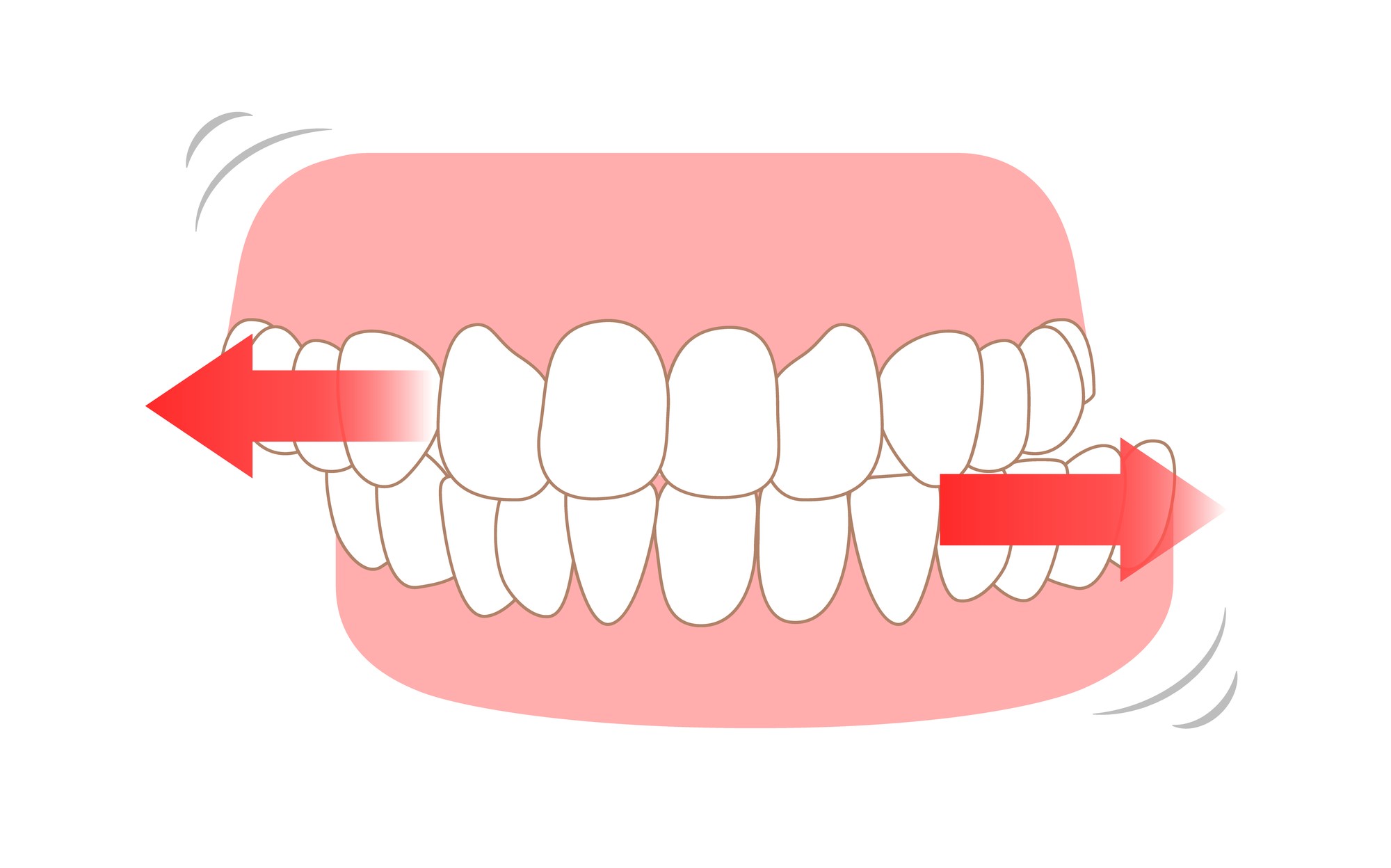 歯ぎしりの治療