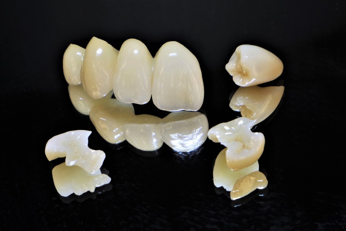 詰め物・被せ物の修正治療