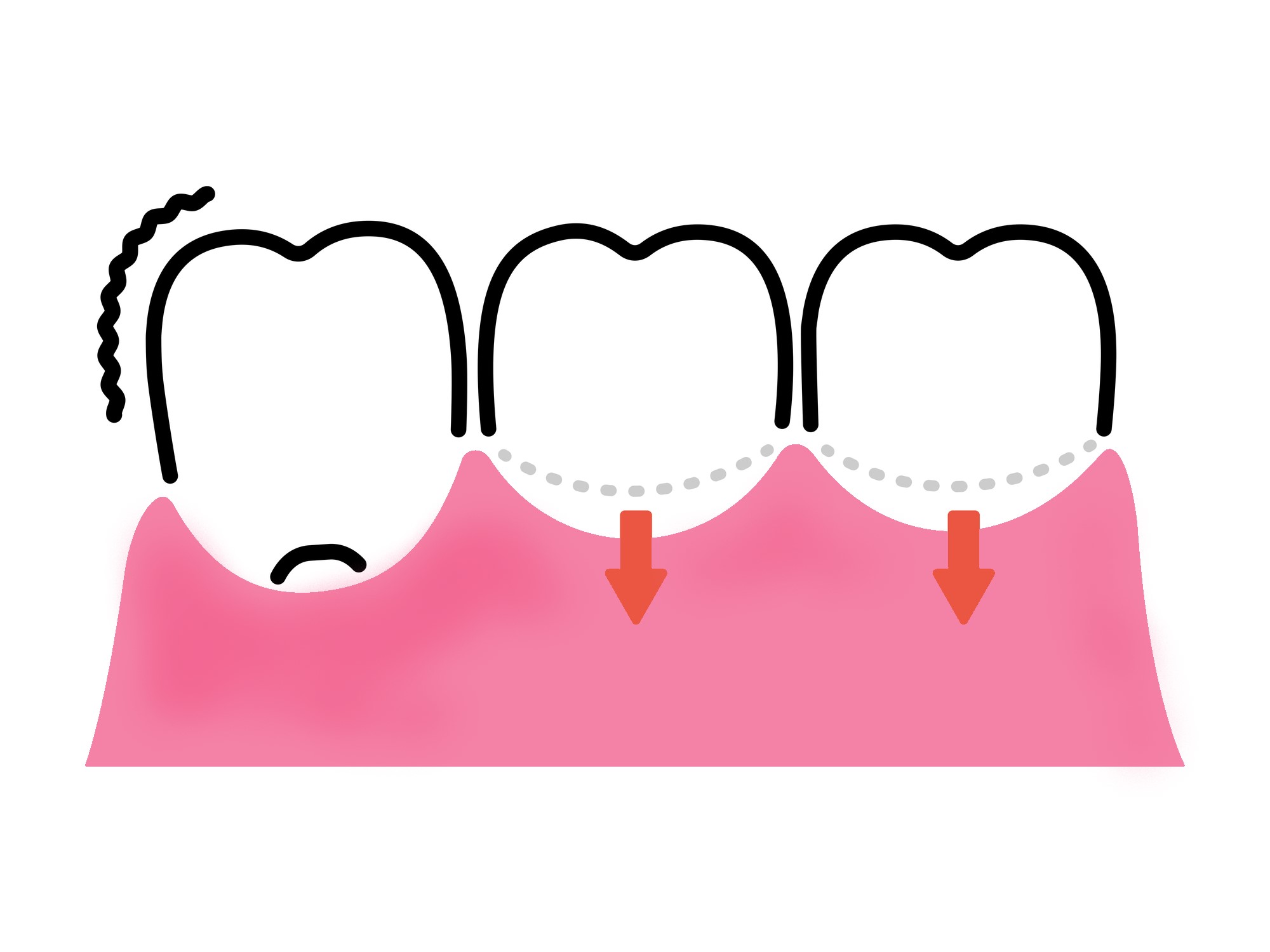 歯ぐきが下がってお悩みの方へ