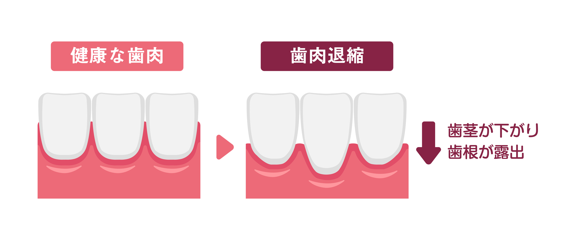 歯ぐきが下がる「歯肉退縮」とは