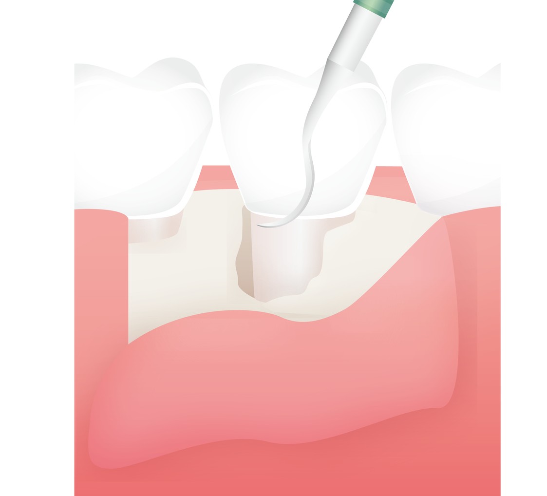 歯肉剥離掻爬手術（フラップ手術）